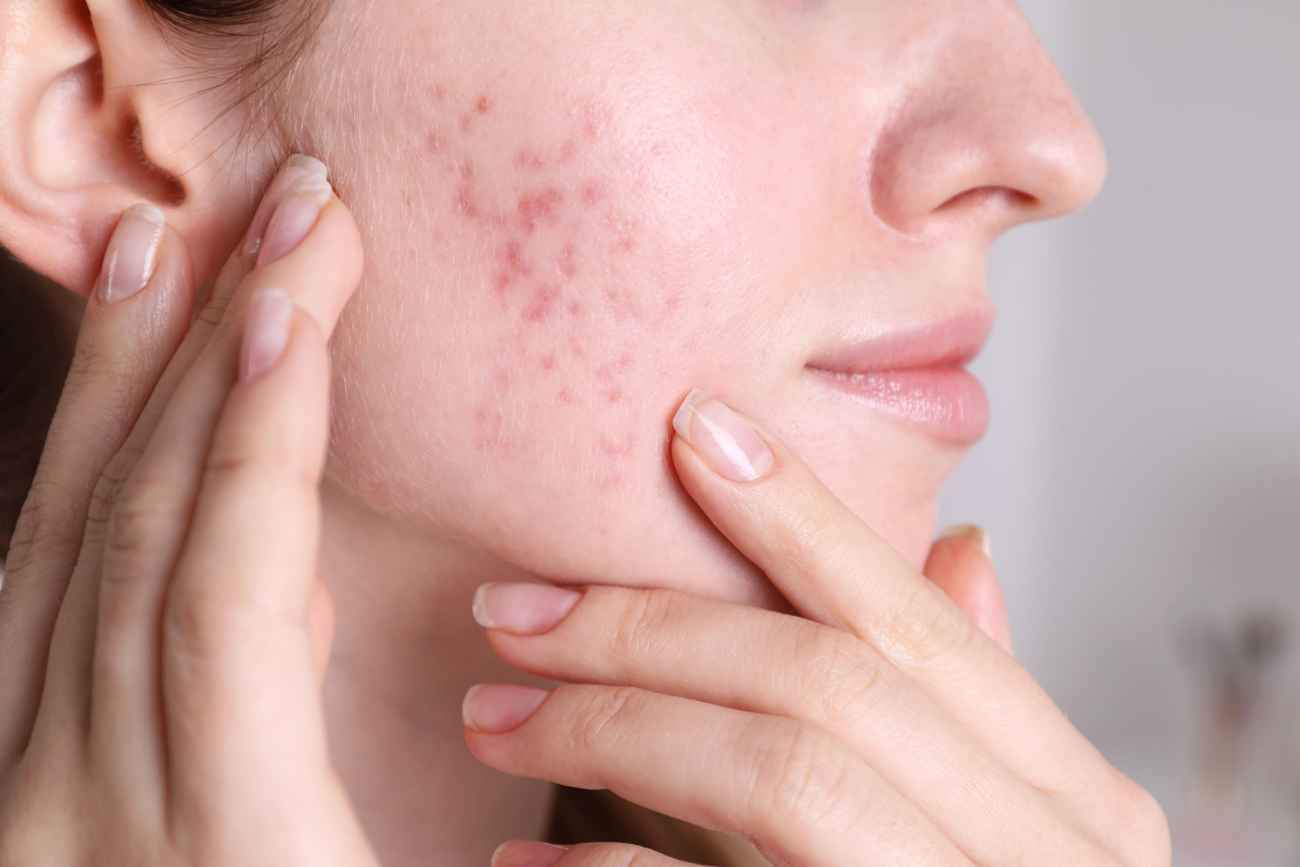 Tratamento Acne