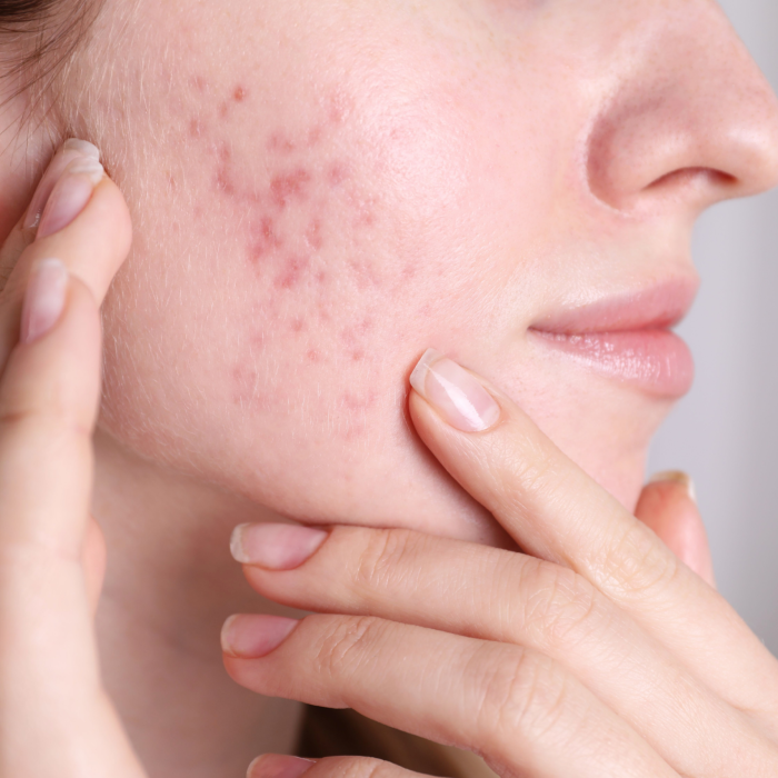 Tratamento Acne